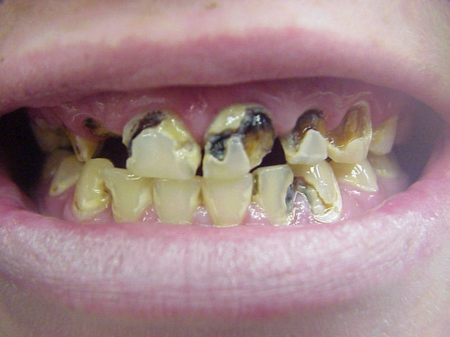 Зубы бывают разные...
