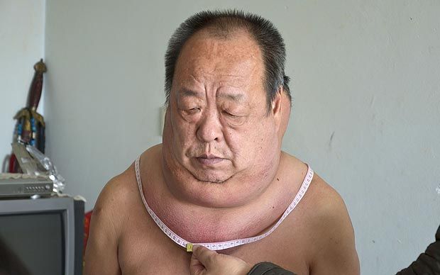 Китаец вынужден жить с огромной опухолью вокруг шеи