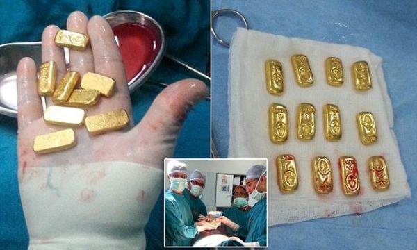 12 золотых слитков найдены внутри бизнесмена, который пожаловался на боли в животе