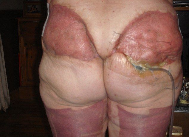 Последствия неудачной операции по удалению лишней кожи