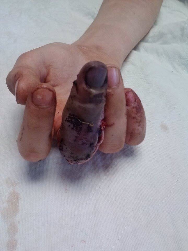 Средний палец два дня спустя после ампутации