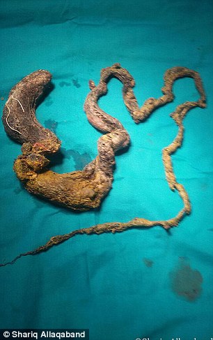 Хирурги удалили из желудка девушки 1.5-метровый ком волос
