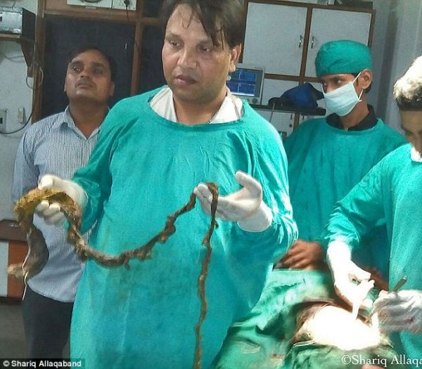 Хирурги удалили из желудка девушки 1.5-метровый ком волос