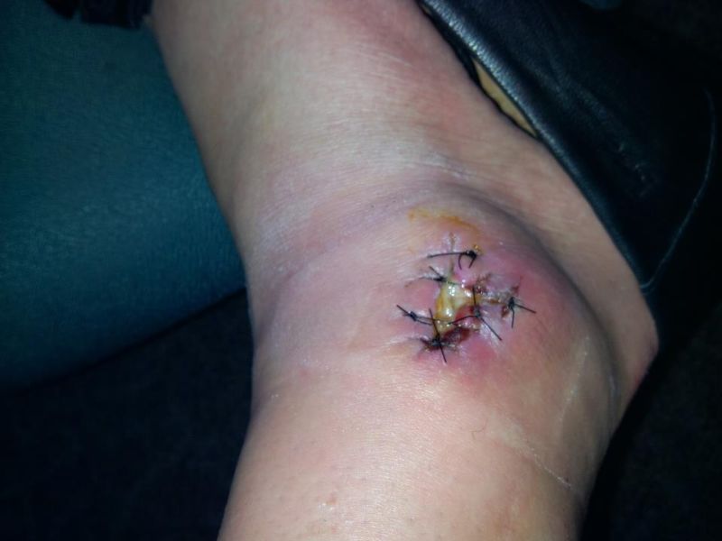 Нога женщины после укуса коричневого паука-отшельника