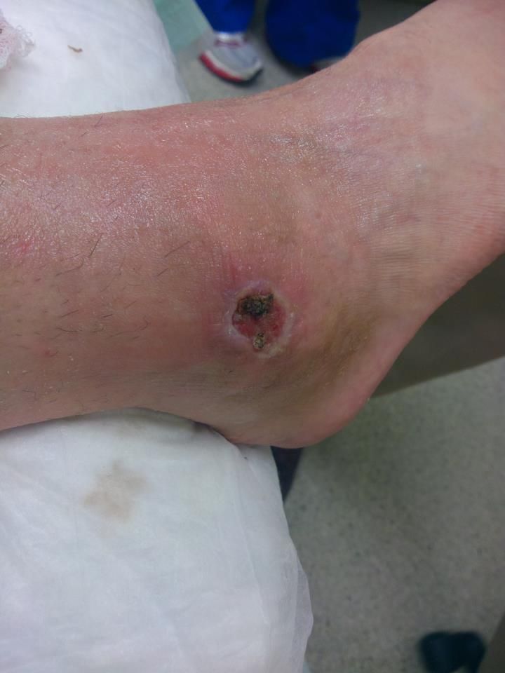 Нога женщины после укуса коричневого паука-отшельника