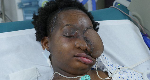 Врачи 39 часов удаляли 2-килограммовую опухоль с лица девушки