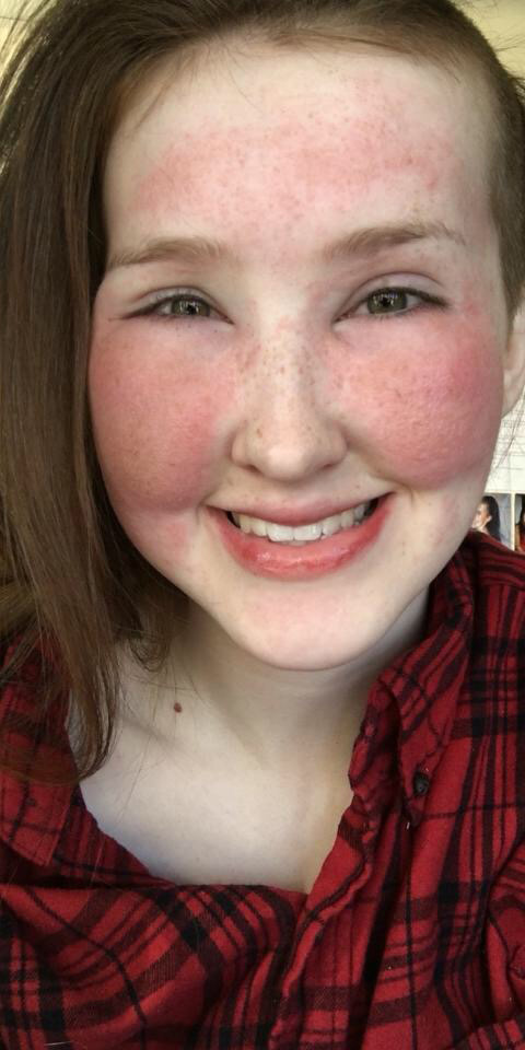 Лицо девушки с аллергией на косметику до и после нанесения макияжа