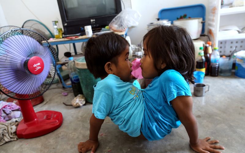 Сиамские сестры-близнецы из Таиланда не хотят, чтобы их разделяли
