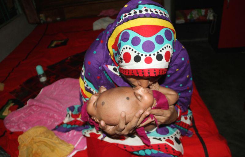В Бангладеш родились близнецы с одной головой на двоих