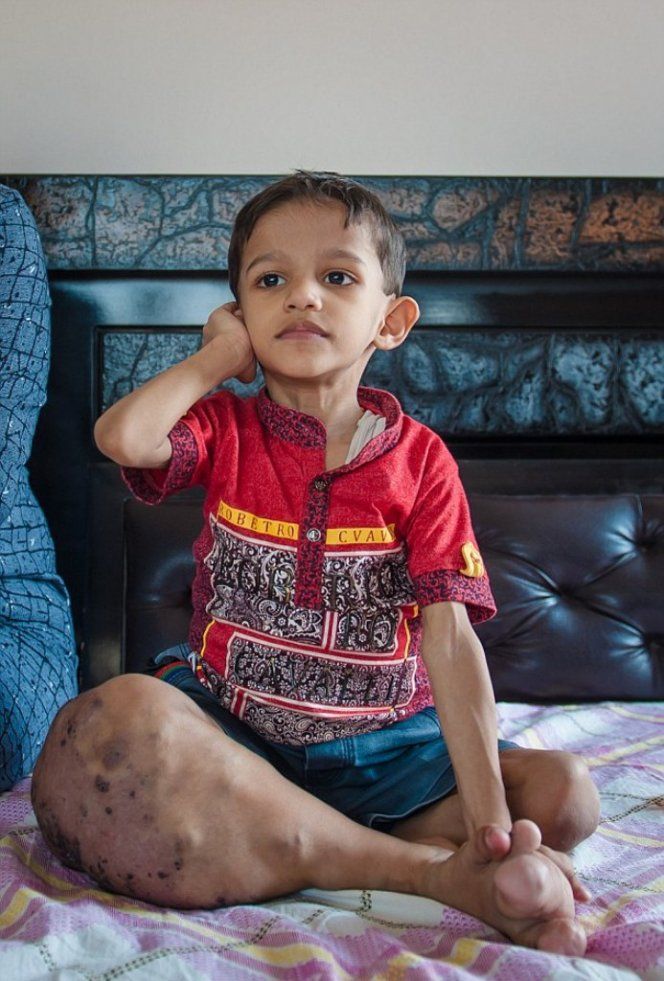 Нога индийского мальчика выросла вчетверо больше нормы