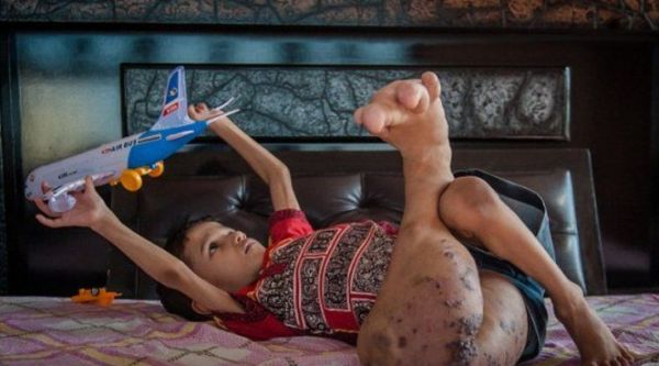 Нога индийского мальчика выросла вчетверо больше нормы