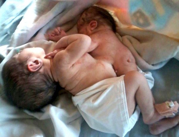 В Индии младенец родился с головой и руками близнеца-паразита, торчащими из груди
