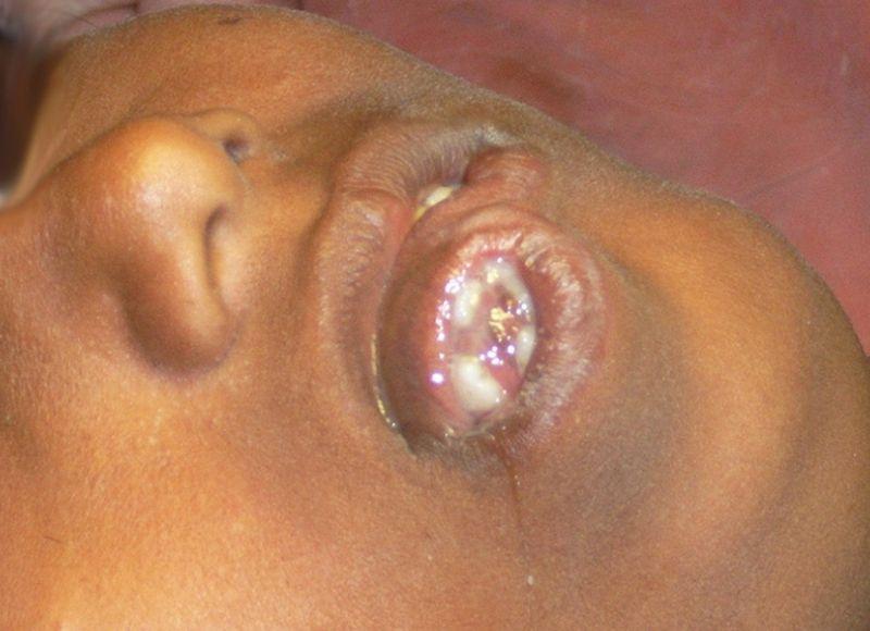 Операция по удалению лишнего рта у индийской девочки