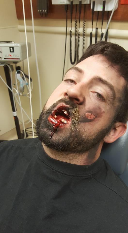 Он закурил электронную сигарету — и тут же потерял 7 зубов
