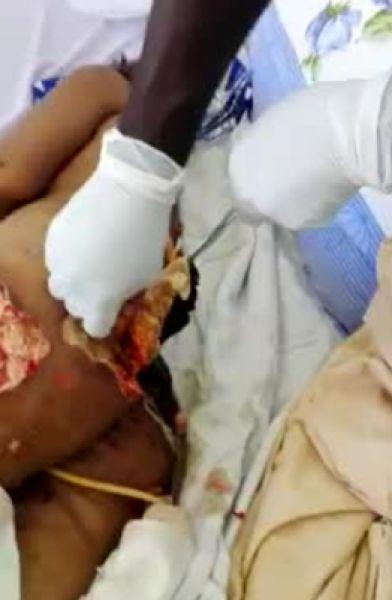 Задница американки взорвалась после пластической операции в Бразилии