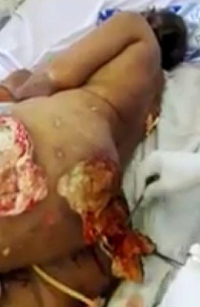 Задница американки взорвалась после пластической операции в Бразилии