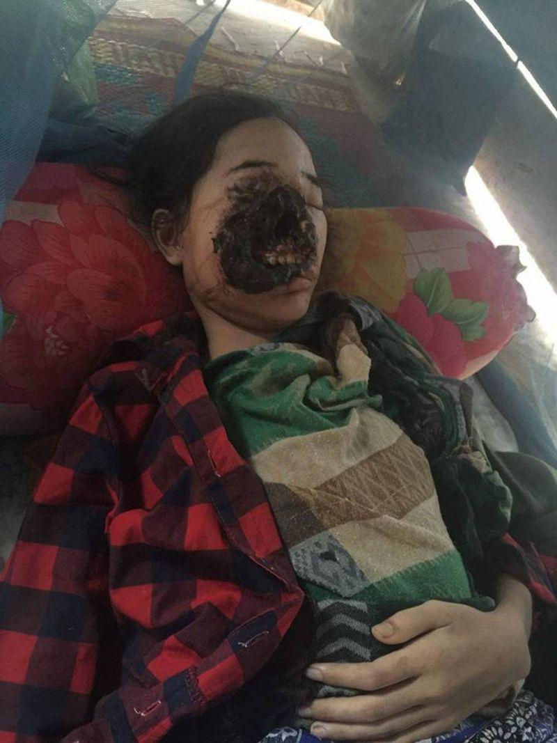 Девушка заразилась у стоматолога бактериями, которые съели ее лицо