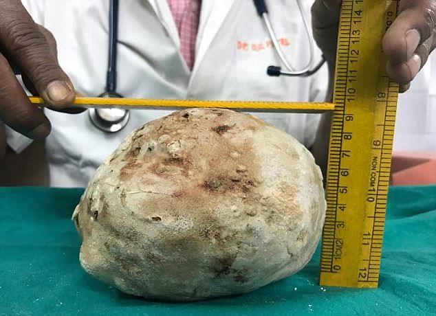 Хирурги вытащили из мочевого пузыря пациента огромный камень