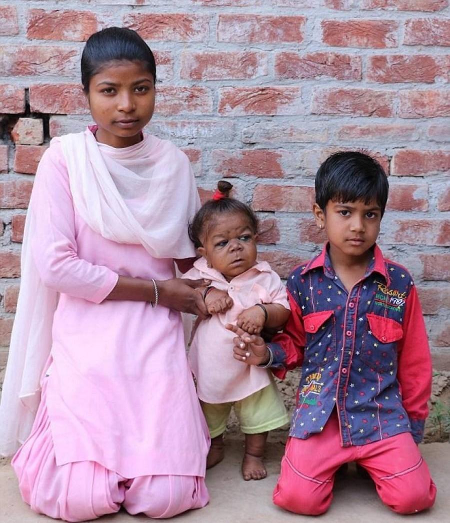 21-летний индиец застрял в теле младенца