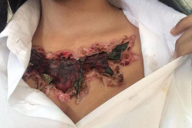 Девушка неудачно удалила татуировку