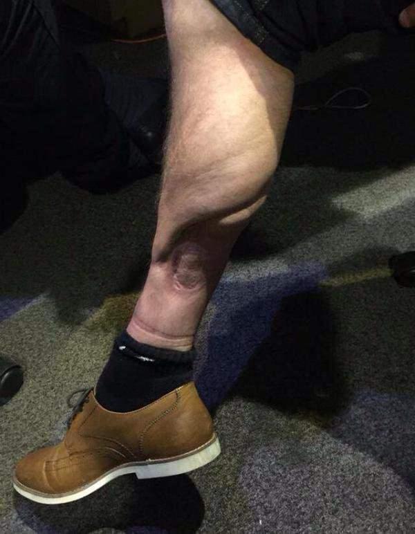 Нога футболиста через 22 года после хардкорного перелома