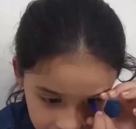 Глазной протез 10-летней девочки