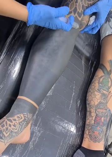 Процесс удаления татуировки⁠⁠