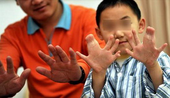 Мальчик у которого 33 пальца