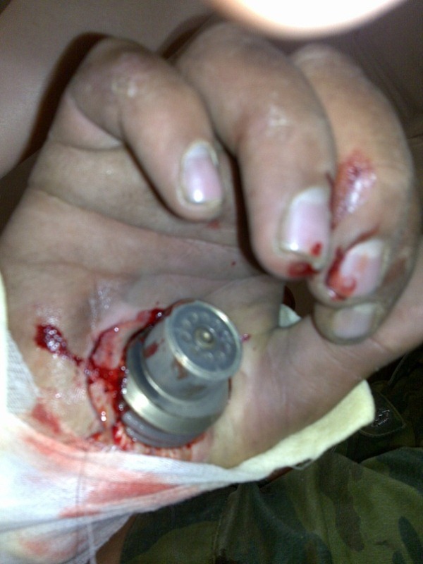 Фото ранения гранатой застрявшей в руке