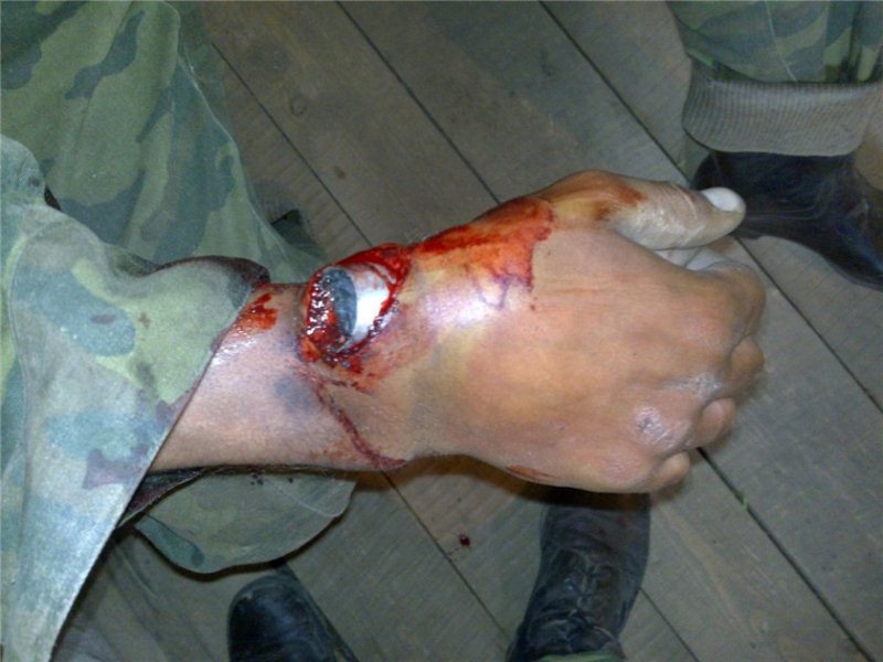 Фото ранения гранатой застрявшей в руке