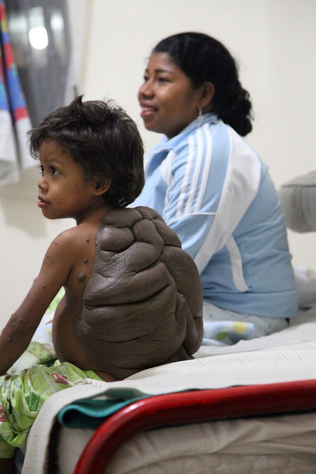 Мальчик-черепаха из Колумбии