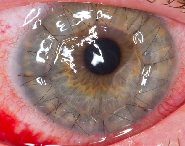 Швы после операции по трансплантации роговицы глазного яблока