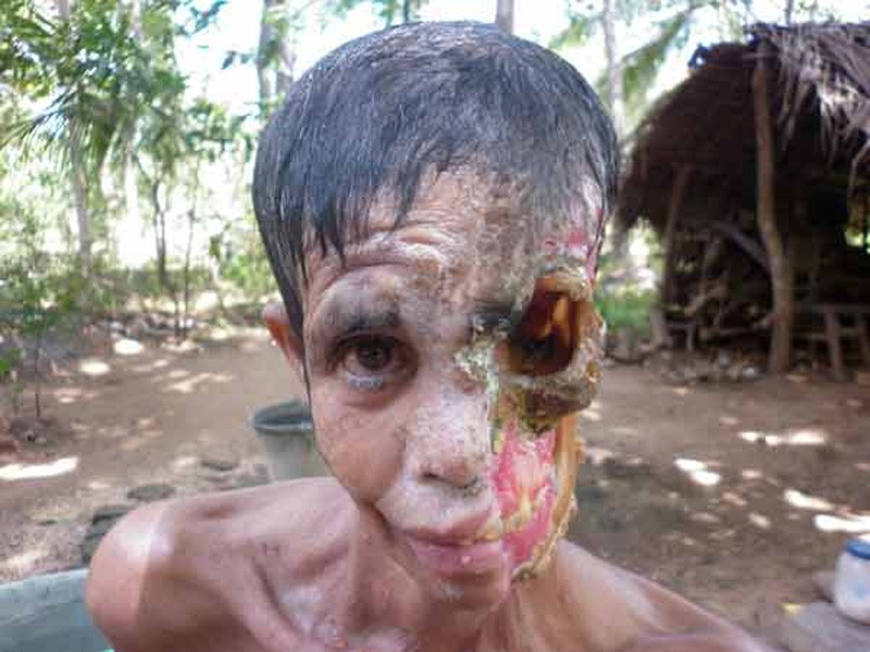 Тропическая инфекция съела лицо
