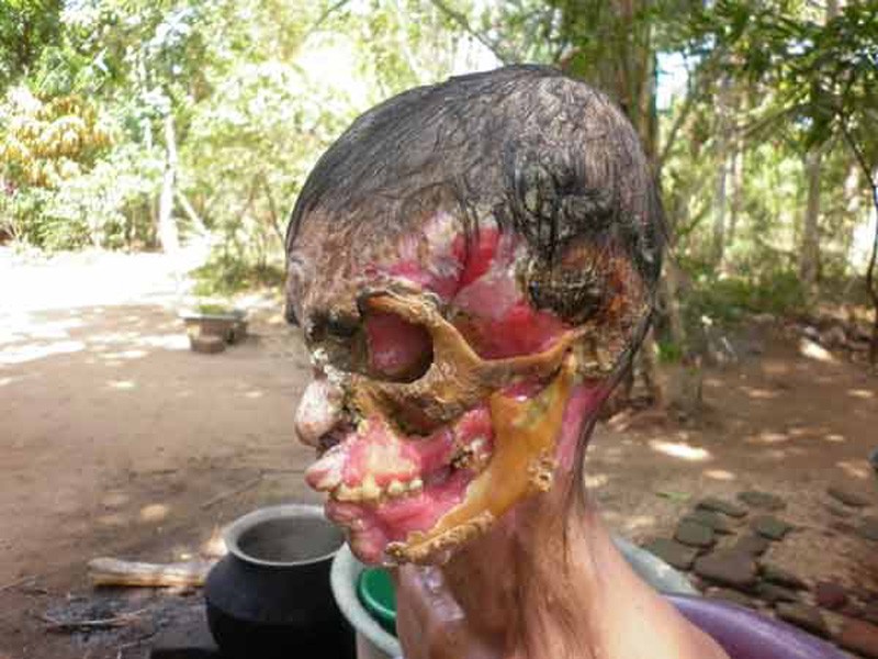 Тропическая инфекция съела лицо
