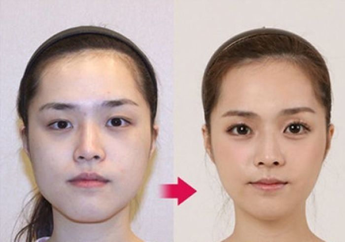 Южнокорейские красавицы до и после работы пластических хирургов