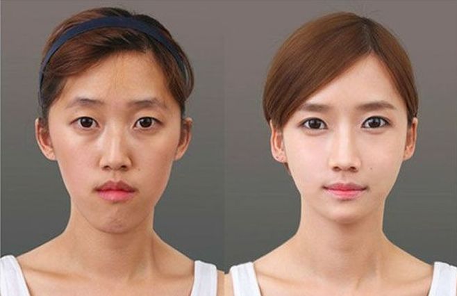 Южнокорейские красавицы до и после работы пластических хирургов