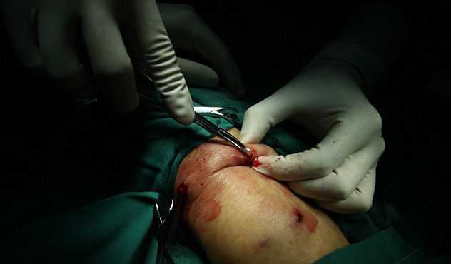 Хирурги извлекли из пациента 42 жемчужины