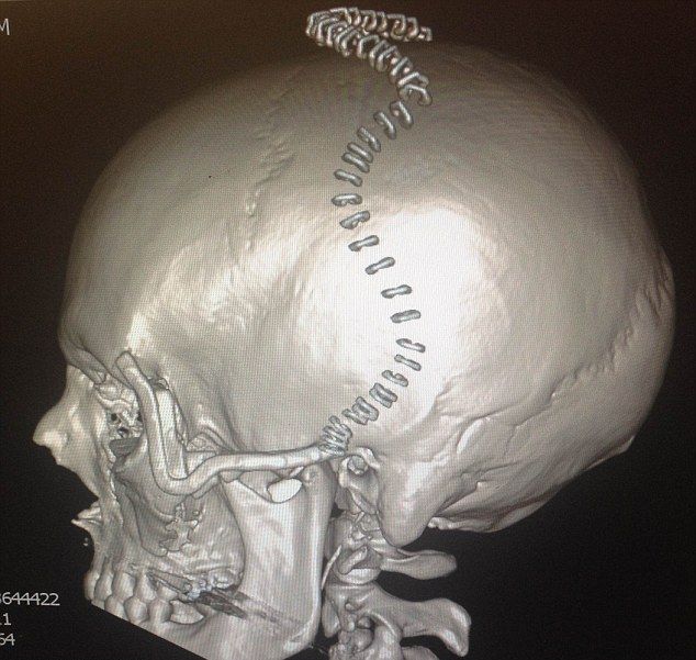 Медики распечатали жертве аварии новый череп