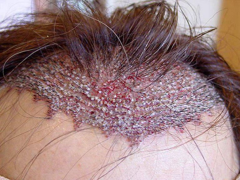 Голова человека после операции по пересадке волос