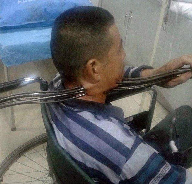 Китайского строителя привезли в больницу с шестью стальными прутьями в шее