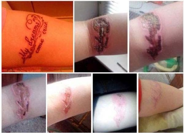 Последствия выведения татуировок чистотелом