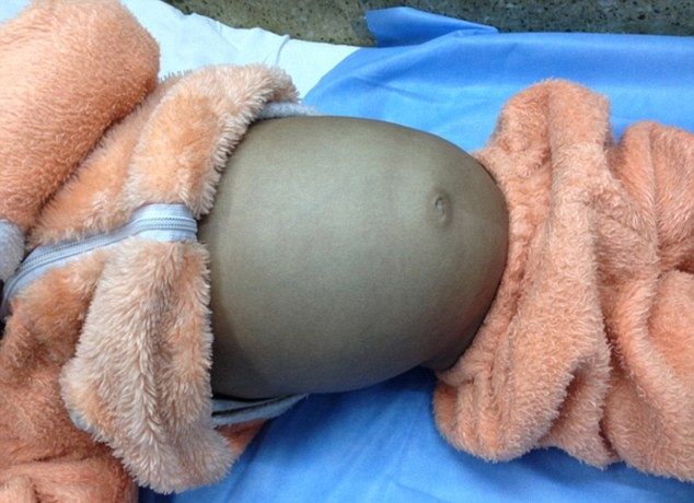 Хирурги вытащили из живота четырехлетнего малыша метровую шевелюру