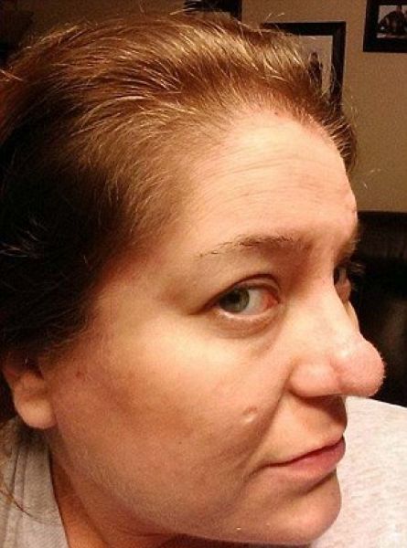 После пересадки кожи учительница вынуждена регулярно брить нос