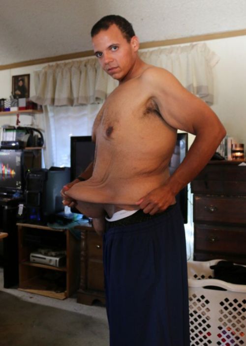 Американец похудел на 181 кг и столкнулся с проблемой лишней кожи