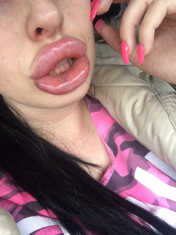 Накаченные губы фото девушек с лицом