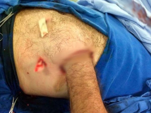 Хирурги спасли руку мужика, зашив ее в живот