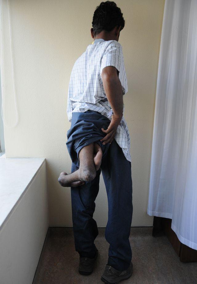 Молодой индиец с четырьмя ногами просит врачей избавить его от лишних конечностей