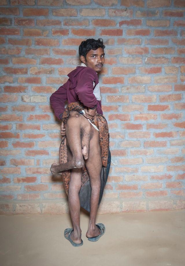 Молодой индиец с четырьмя ногами просит врачей избавить его от лишних конечностей