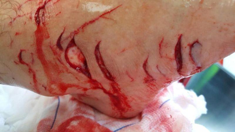 Нога серфера после атаки тупорылой акулы