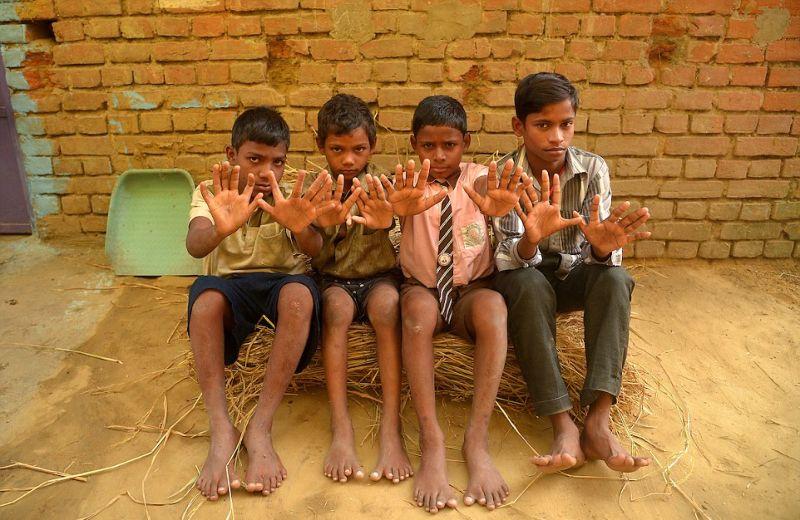 Индийская семья из 25 человек, у которых по 12 пальцев на руках и ногах